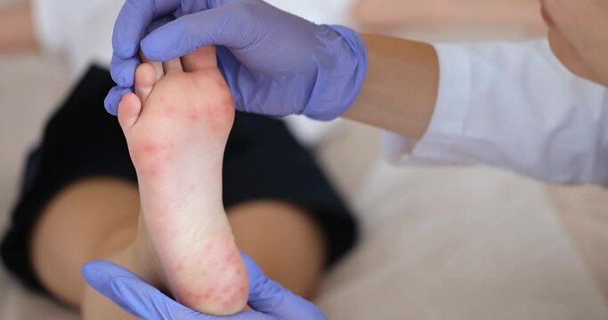 Doctor dermatologist examining red rash on feet of child closeup 4k movie