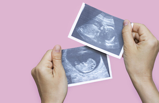 pregnancy and baby waiting. ultrasound picture with fetus in uterus in woman's hand,on pink background.2 different gestation periods.sonogram of fetus, unborn yet baby, flat lay, love care.hands up