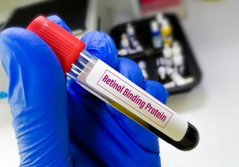 Scientist holding blood sample for Retinol Binding Protein testing which is used to assess renal tubular injury or dysfunction and screening for other tubular abnormalities.