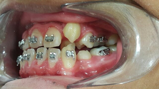 Close up mouth with dental appliance treatment.Picture of Orthodontic technology .Close up of crooked teeth with braces.Teeth cracker image.Patient mouth before braces case study for dentist