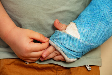 Broken hand blue plaster cast after accident torching fringes