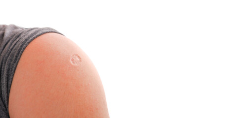 Monkeypox and smallpox vaccine scar on human shoulder with copy space on white background