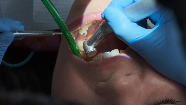 Extreme closeup shot of dental procedure on caucasian female patient with dental turbine handpiece, mirror and saliva ejector in mouth