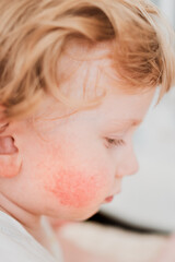food allergy in a young child on the cheeks