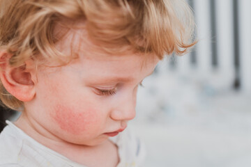 food allergy in a young child on the cheeks