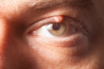 Close up picture of female patient's infected eye. Hordeolum on upper eyelid. Viral Infection....