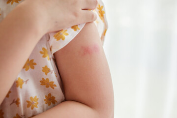 Little girl has skin rash allergy itching and scratching on her arm