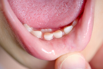 Open mouth of a child with milk teeth. Teeth in two rows. Shark tooth. The permanent incisors grew...
