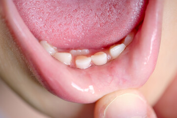 Open mouth of a child with milk teeth. Teeth in two rows. Shark tooth. The permanent incisors grew before the milk teeth fell out.
