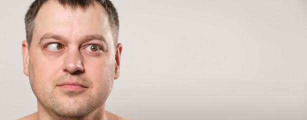 A man with strabismus squints his eyes on a white background, a banner with space for text.