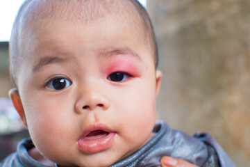 little baby infection at the eyelid caused by being bitten by insects causing swelling and redness...