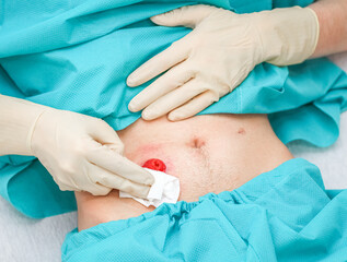A young patient in pajamas and sterile gloves cleans the intestines on his stomach with a napkin.