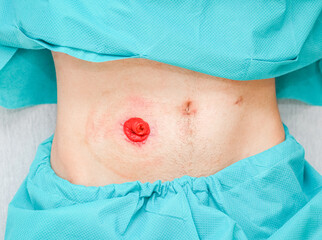 A young patient in pajamas with an open stomach, postoperative scars and a clean intestine out..