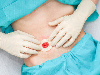 A patient in pajamas applies a sticky circle to the intestine protruding from the abdomen.
