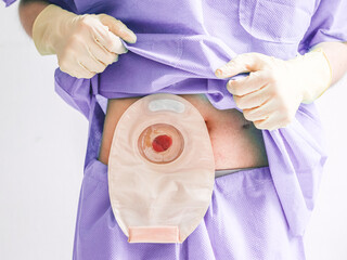 Young patient caucasian male in lilac disposable medical pajamas shows a colostomy bag on his stomac