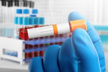 Blood sample of patient for test in laboratory. doctor with Blood tube for Sodium test in lab