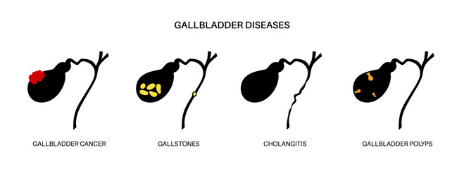 Gallbladder diseases poster - obrazy, fototapety, plakaty