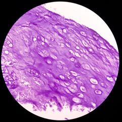 Microphotograph of bone tumor, Enchondroma, show bony tissue features of enchondroma,Benign bone tumor.