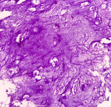 Microphotograph of bone tumor, Enchondroma, show bony tissue features of enchondroma,Benign bone tumor.
