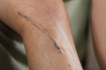 Metal staples or stitches over a fresh wound after knee surgery. Wound and stitches covered with...