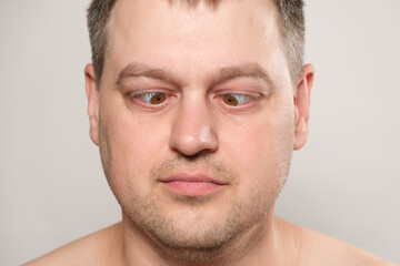 A man does exercises for the eyes, looks at the nose, brings his eyes to the center.