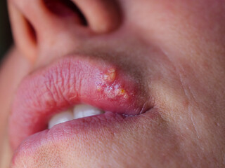 CLOSE UP: Detailed view of herpes simplex on upper lip caused by immune weakness - obrazy, fototapety, plakaty