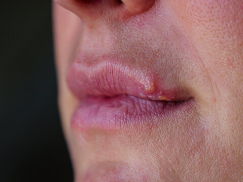 CLOSE UP: Detail view of top lip affected with blister caused by herpes simplex