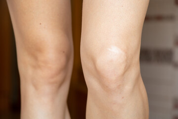 Knee of a young girl with an old scar close-up, legs