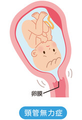 頸管無力症　子宮の中の赤ちゃん　妊娠中の母体の仕組み - obrazy, fototapety, plakaty