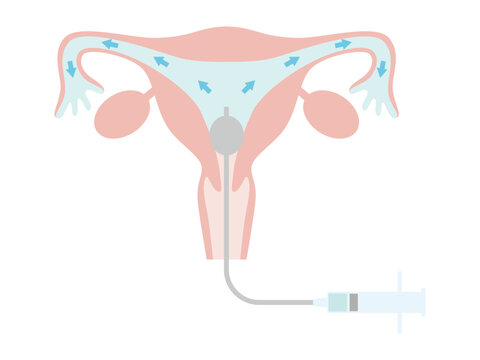 卵管造影検査　不妊治療