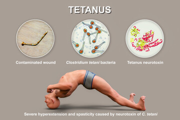 Tetanus disease, opisthotonus in a man suffering from tetanus
