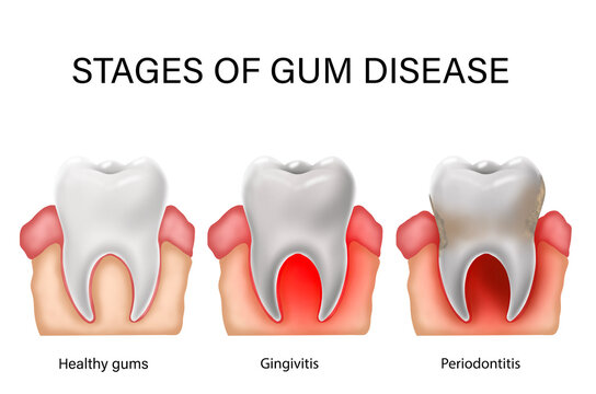 Collage with illustrations of healthy tooth with gum and infected ones showing stages of disease. Gingivitis and periodontitis