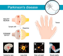 Parkinson's disease Infographic. Symptoms of a parkinsonism. - obrazy, fototapety, plakaty