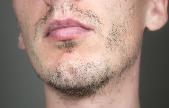 Short, sparse beard on mans face. Hair growth problems. Man with alopecia area in the beard. Unshaven bristles on the beard.