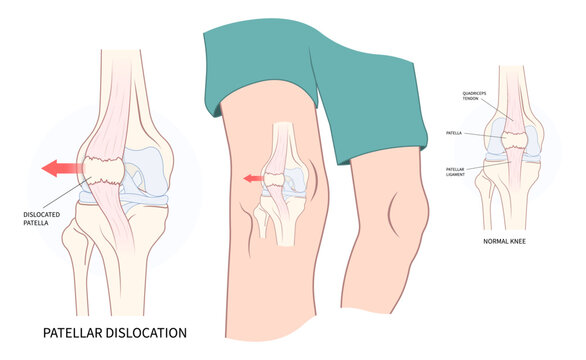 Knee Injury And Cause The Patellar Dislocated And Subluxation Patella Dysplasia Painful Joint