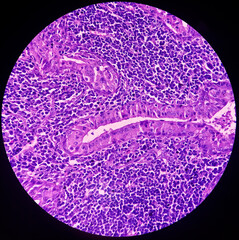 Infected pre auricular lymph node(biopsy): Warthin Tumor, show lymph node tissue. Also known as papillary cystadenoma lymphomatosum, is a benign cystic tumor.