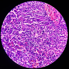Infected pre auricular lymph node(biopsy): Warthin Tumor, show lymph node tissue. Also known as papillary cystadenoma lymphomatosum, is a benign cystic tumor.