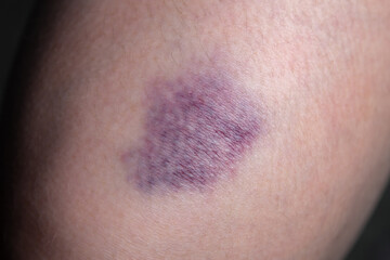 Image of the bruise on woman leg