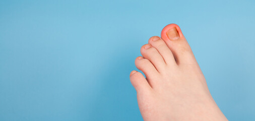 Ingrown Toenail Problem. Infected Foot Check. Podiatry Patient. Treats ingrown nail. Concept body care. injured toenail in, close up banner image on blue background. Nail problem