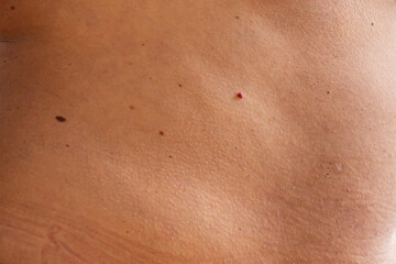 skin with moles