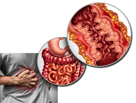 and Crohn syndrome illness or crohns illness and healthy colon as a medical concept with a close up of a human intestine with inflammation symptoms causing obstruction as a 3D illustration elements.