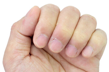Close-up of fingers and nails with dry skin, torn and flaking off, cracked skin on cuticles, dry brittle nails. Broken fingernails inflammation. Chipped nails. Isolated on white background.