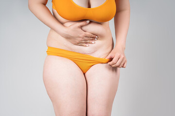 Female belly with a scar from a caesarean section on a gray background