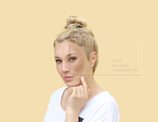 Dark spots, freckles,hyperpigmentation(melasma or chloasma),concept - skin lightening, skin whitening, fruit acids,AHA, Skin Brightening