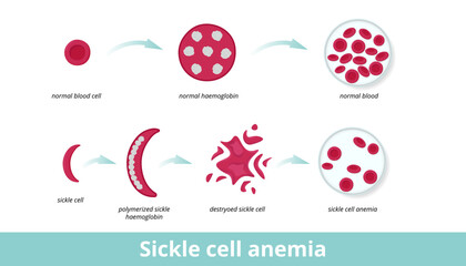 Fototapeta na wymiar Sickle cell anemia. Sickle cell anemia (disease) occurs due to sticky sickle cells damaged long polymerized sickle haemoglobin that distorts erythrocyte round shape.