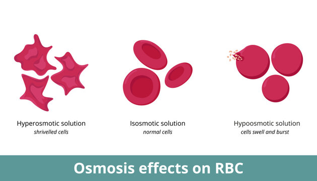 Osmosis effect on red blood cells. Depending on solution concentration (hyperosmotic, isosmotic, or hypoosmotic), erythrocytes can shrivel or swell and burst.