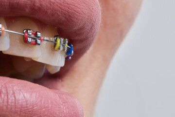 Dental procedure for installing braces close up.The procedure for the care of teeth and gums in the...