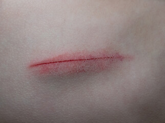 Skin abrasion or scratch on the abdomen. Medical abrasion, injury or wound