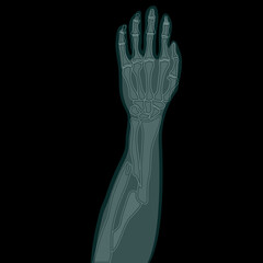 broken arm x-rays vector illustration