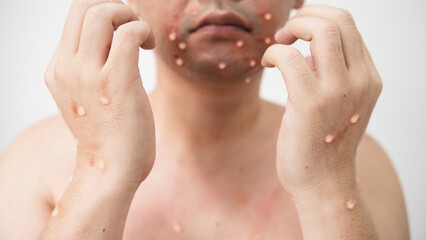Concept of monkey pox infection, a white Asian man with pustular skin from monkeypox virus...
